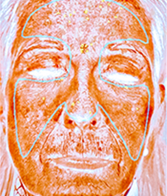 BROWN SPOTS